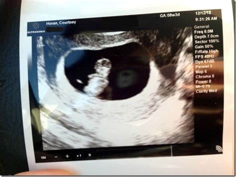 What to expect during dating ultrasound. What to Expect at 12 Week Prenatal Appointment