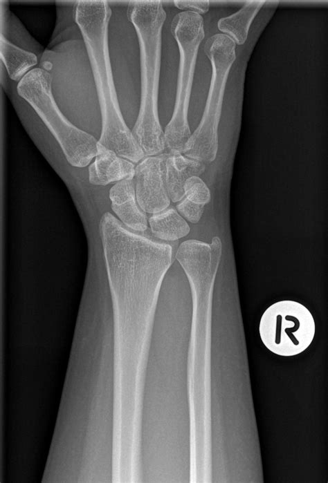 Normal Wrist X Rays Image