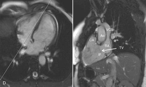Size And Function Of The Right Ventricle Radiology Key