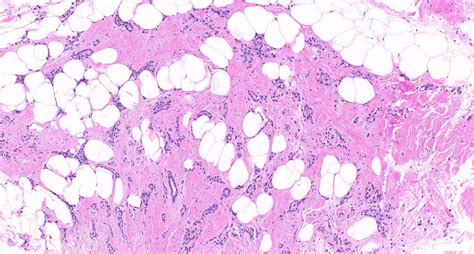 Pathology Outlines Invasive Breast Cancer Of No Special Type Nst