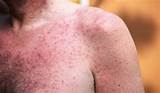 Pictures of How To Treat Heat Rash In Adults