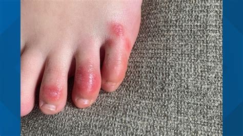 What Are Covid Toes New Skin Condition Possibly Linked To