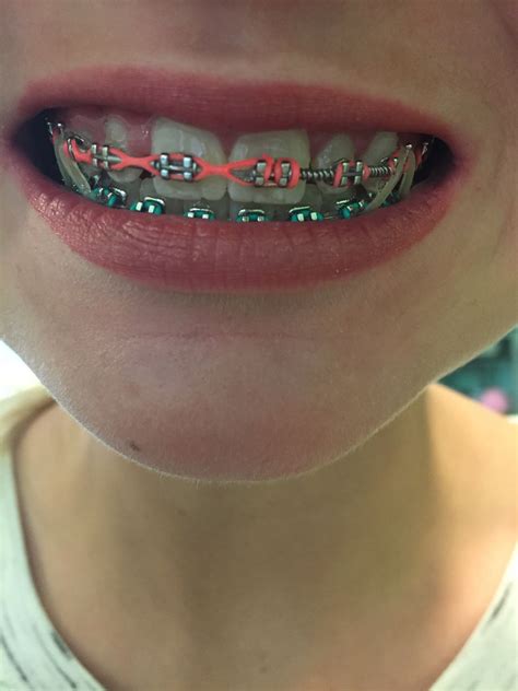 Pin By Stephanie Knight On Braces Braces Colors Braces Tips Cute