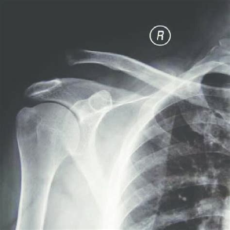 Acromioclavicular Joint Dislocations Treated With Coracoclavicular
