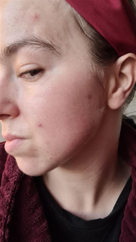 Cystic Acne Or Irritation Rtretinoin