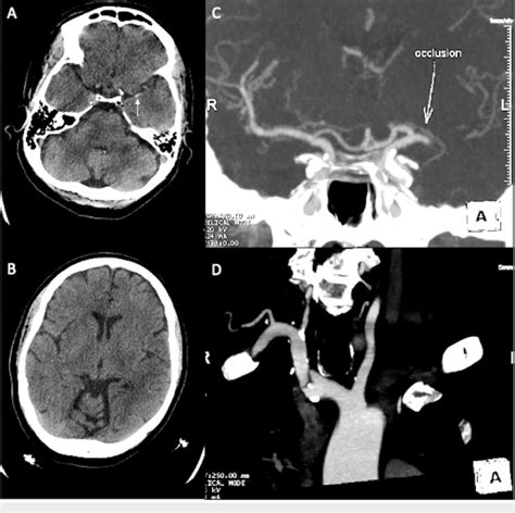 Case 1 Neurological Imaging A Ct Of The Head Shows A Left Mca