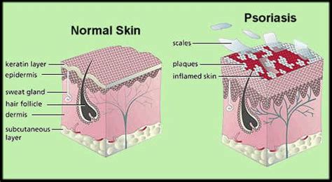 Normal Skin Vs Psoriasis Psoriasis Plaque Psoriasis Treatment