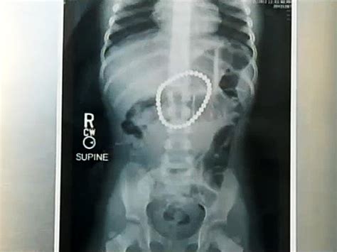 Swallowed Razor Blade Shocking Medical Scans Pictures Cbs News