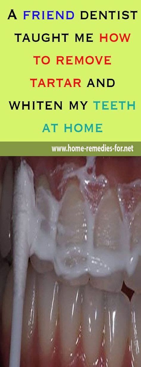 A Friend Dentist Taught Me How To Remove Tartar And Whiten My Teeth At