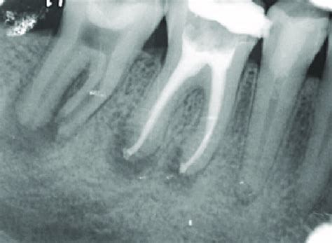 Preoperative Periapical Radiograph Showing A Radiolucency And