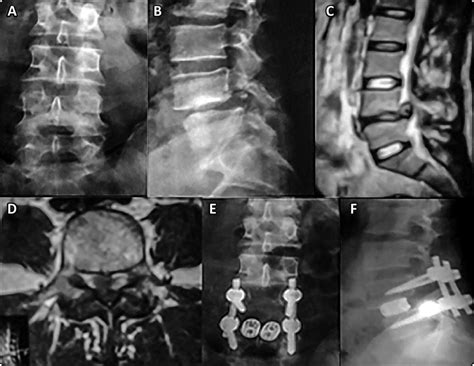 Ab Standing Ap And Lateral Plain Radiographs Showing Download