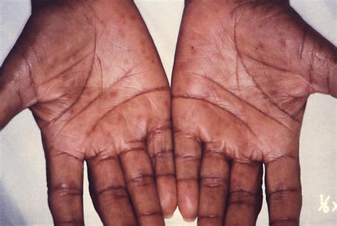 Medical Pictures Info Syphilis Rash