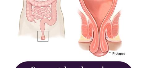 Colon cancer and hemorrhoids often present with the same symptoms. Can Rectal Prolapse Be A Sign Of Cancer?