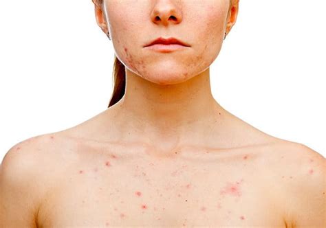 Dermatite Da Stress Sintomi Cause Sintomi E Rimedi Eucerin