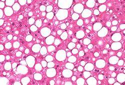 Неалкогольный жировой гепатоз диета Можно ли вылечить неалкогольный жировой гепатоз печени полностью? Можно ли вылечить неалкогольный жировой гепатоз печени полностью? Неалкогольный жировой гепатоз диета