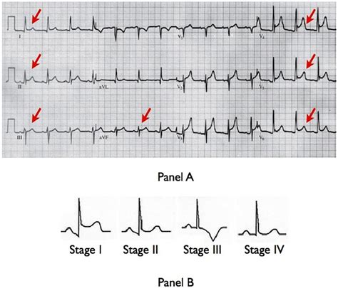 Pericarditis can be caused by a number of conditions, including infection, heart attack infections that can produce pericarditis include viral infections, bacterial infections, tuberculosis, and. Diagnosis and treatment of pericarditis | Heart