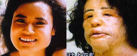 Surgery gone wrong japanese av star's plastic surgery obsession leaves her looking like d. Chatter Busy: Hang Mioku Plastic Surgery Disaster