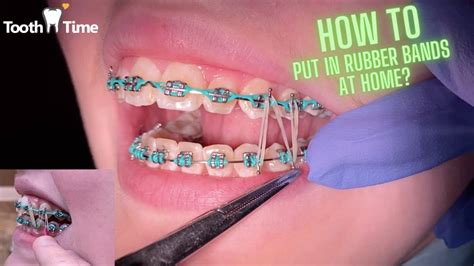 How To Put On Rubber Bands On Braces With Nails Check Out The Link Below To Pick Up The
