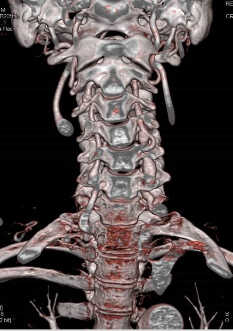 Pdf Transclival Clipping For Giant Vertebral Artery Aneurysm A Case