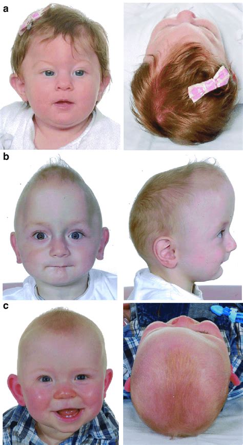Preoperative Clinical Presentations Of Craniosynostosis Crs In