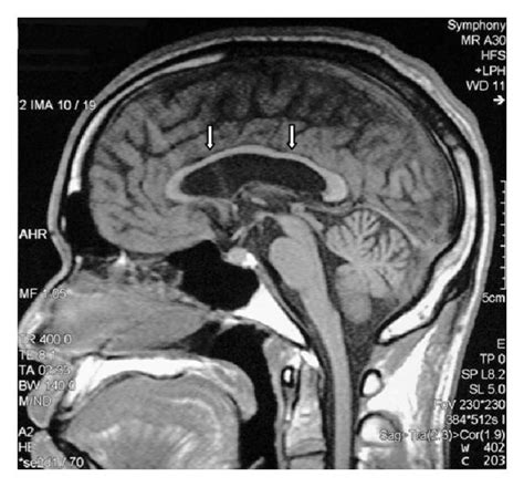 Sagittal T1 Weighted Mr Image Of The Brain Shows Thinning Of The Corpus