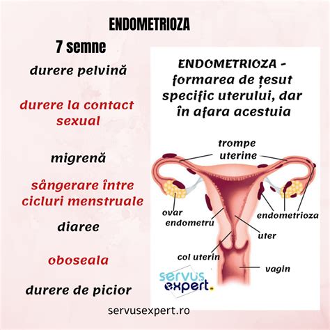 Endometrioza este o afecțiune dureroasă în care țesut specific uterului