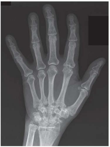 Hand And Wrist Radiology Key