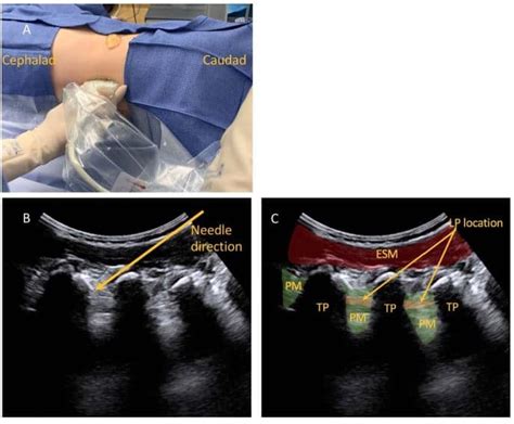 Ultrasound Guided Lumbar Plexus Blocks In Paediatric Patients Wfsa