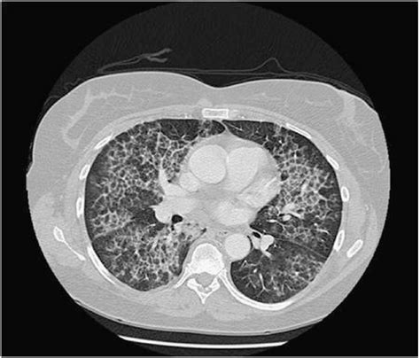 Thorax Ct Scan