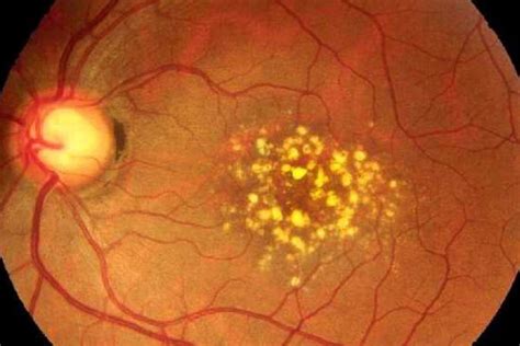 Drusen Causes Symptoms And Risks Eye Conditions The Eye News