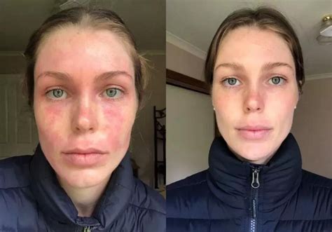 Eczema Before And After Photos Mukti Organics
