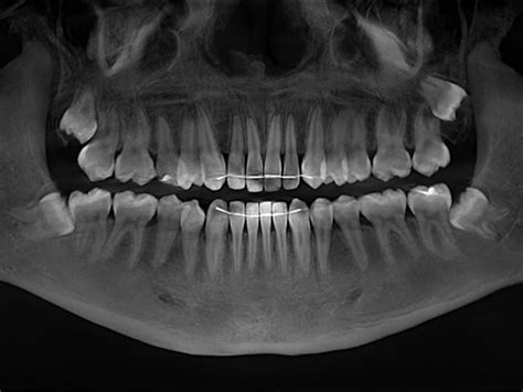 Wisdom Teeth Removal Dentalmed Associates