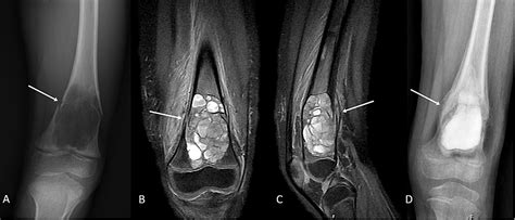 Cureus Aneurysmal Bone Cyst Of The Distal Femoral Metaphysis In A Four Year Old Female Patient