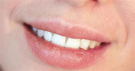 Itchy Lips Symptoms Causes And Home Remedies