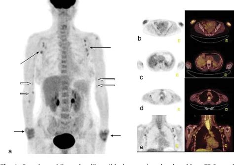 Figure 1 From Epitrochlear And Axillary Lymph Node Visualization On Fdg