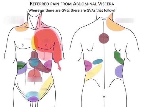 Abdomen Referred Pain Diagram Quizlet