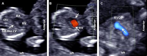 Example Demonstrates Hypoplastic Left Heart Related Ultrasound Findings