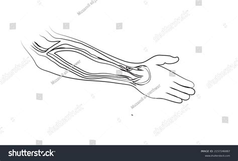 Illustration Arteriovenous Fistula An Arteriovenous Av Stock Vector