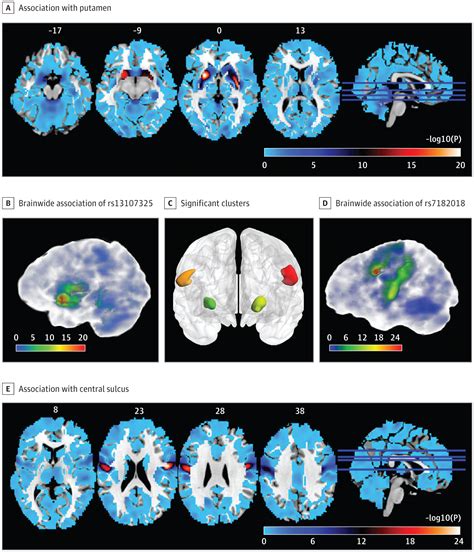 Schizophrenia Linked To Genetic Structural Abnormality In Adolescent Brain News