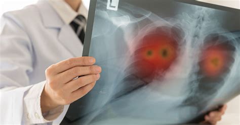 Current Lung Cancer Screening Guidelines Miss Many Young High Risk