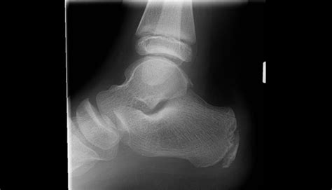 Ortho Dx Heel Pain In A Child Who Plays Soccer Every Day Clinical