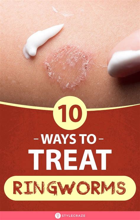 10 Ways To Treat Ringworms In 2020 Home Remedies For Ringworm