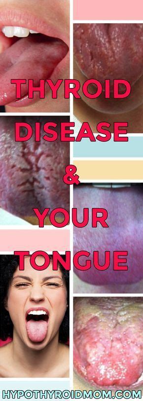 What Your Tongue Tells You About Your Thyroid Lowthyroid Thyroid