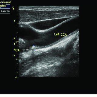 Carotid Duplex Scanning Showing Significant Atherosclerotic Plaque