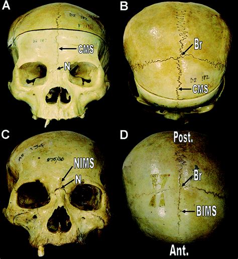 Showing Representative Dried Skulls With Variant Metopic Sutures A