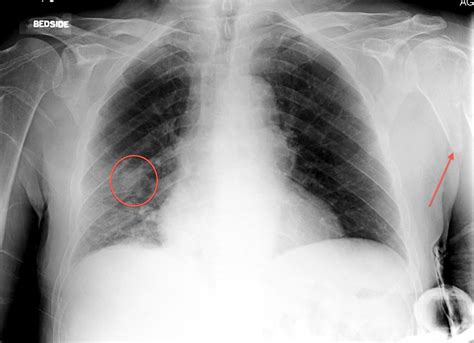 Lung Cancer With Bone Metastasis Radiology At St Vincents