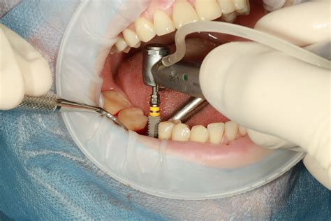 Cómo se desarrolla la cirugía de un implante dental