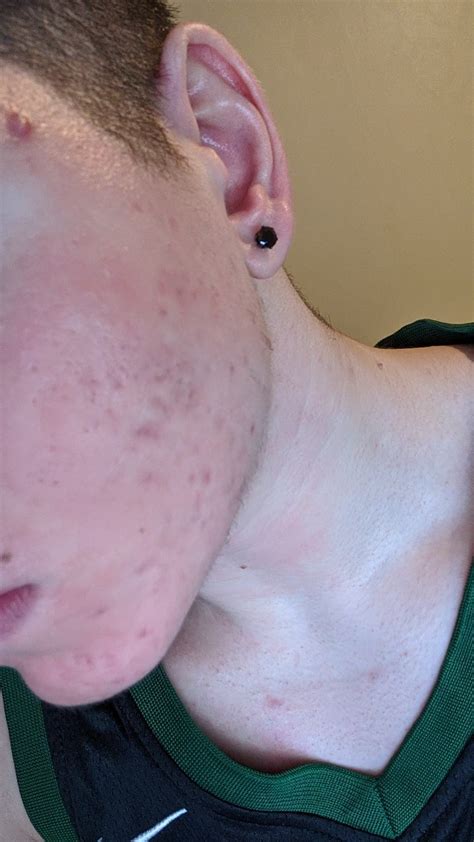 Are These Acne Scars If So How Do I Treat Them To Go Away Or Fade