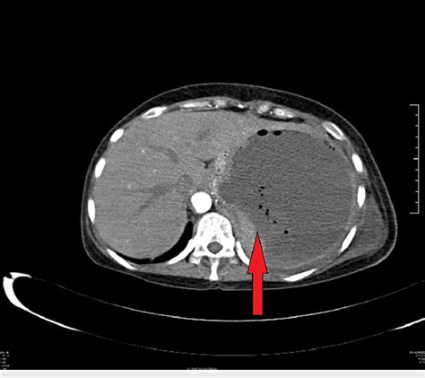 Ct Abdomen Showing Splenic Abscess With Air Foci Download Scientific