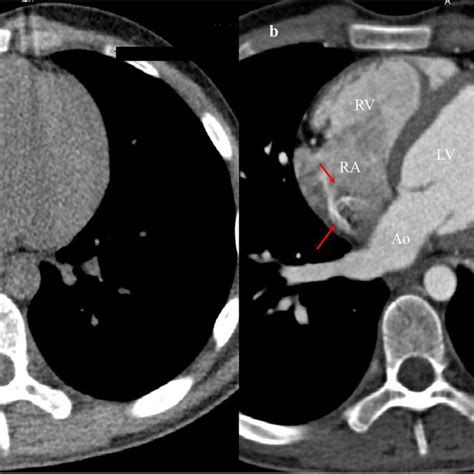 Ct Showed The Large Calcified Thrombus In The Right Atrium Download